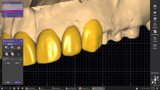 exocad wax up mock up смотреть онлайн