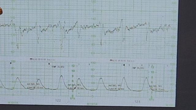 CTG interpretation Dr Abdulrahim Gari смотреть онлайн