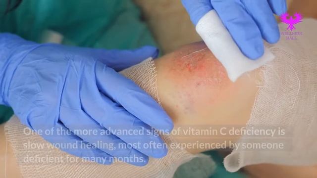 The Symptoms of Vitamin C Deficiency You Shouldn't Ignore смотреть онлайн