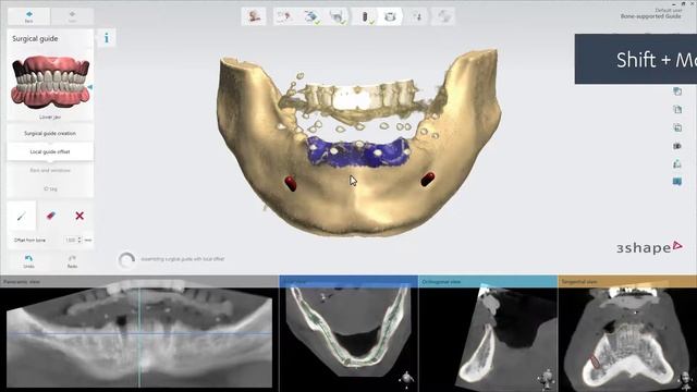 3Shape Implant Studio - How to create an advanced bone-supported surgical guide using local offsets смотреть онлайн