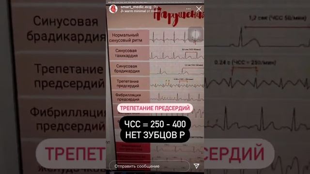 #экг ритм сердца 💞 смотреть онлайн