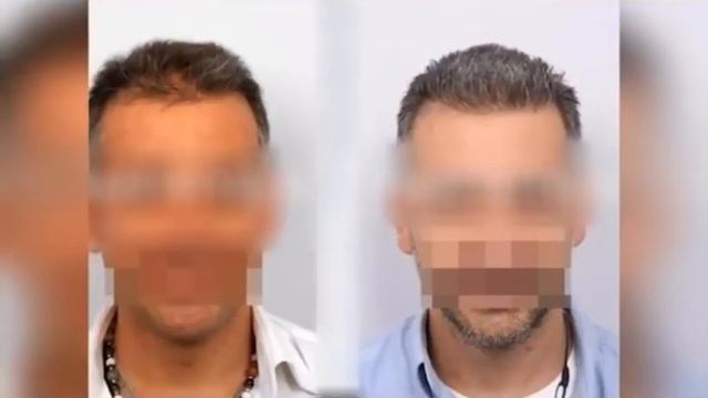 Euro pro hair clinic | شاهد نتائج زراعة الشعر قبل وبعد смотреть онлайн
