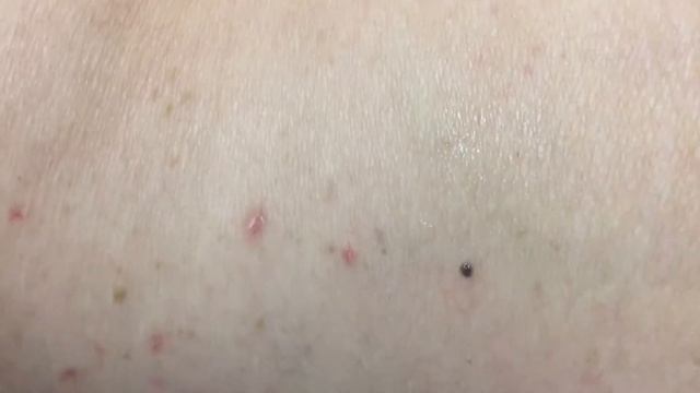 rimozione laser di neoformazioni vascolari angiomi e emangiomi Laser Lumenis M22 смотреть онлайн