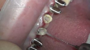 Восстановление культевыми вкладками шести передних зубов. Карнеев Андрей - врач стоматолог ортопед.