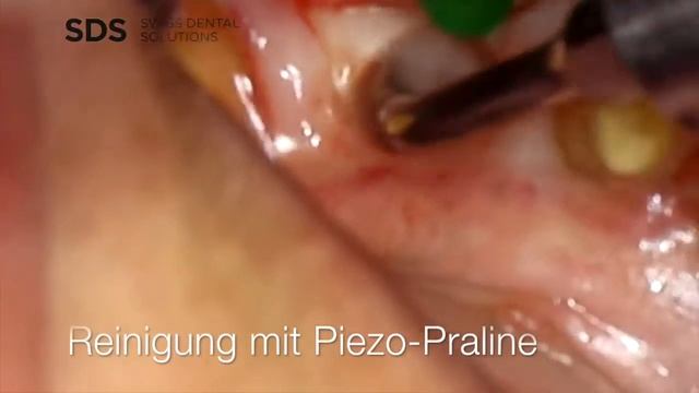 Spätimplantation (regio 36) (SDS 1.1) - Ischämische Osteonekrose смотреть онлайн
