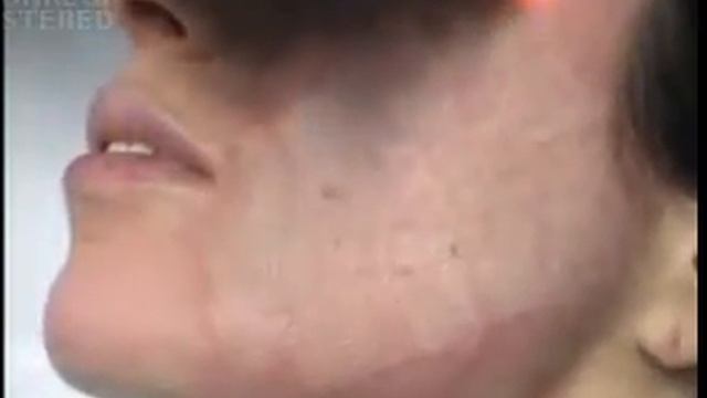 Rejuvenescimento A Laser Fracionado - Smartxide CO2 - Deka Lasers - Resurfacing Da Pele