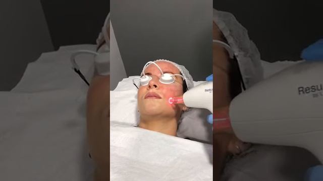 Laser ResurFX Lumenis M22