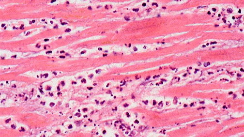 Патологическая анатомия ИБС и ЦВБ смотреть онлайн