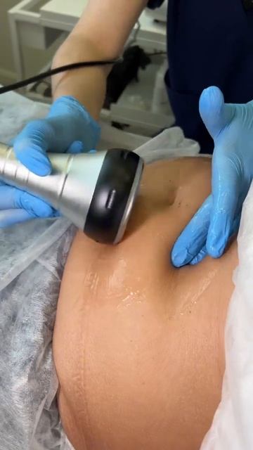 Кавитация (безоперационная липосакция) смотреть онлайн