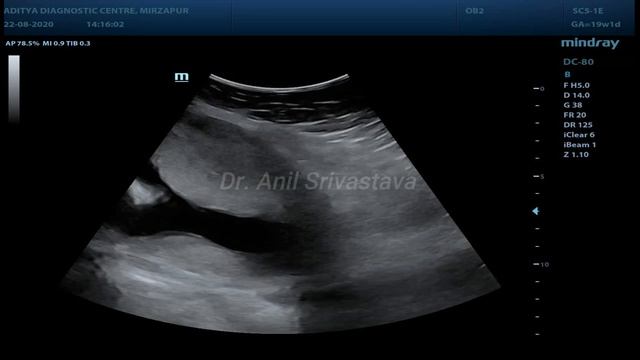 Large lower uterine segment fibroid with 20 Wks pregnancy смотреть онлайн