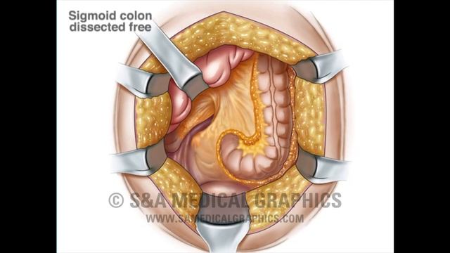 Colostomy Animation