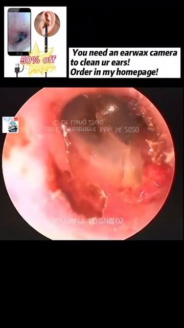Best Ear Wax Removal & Extraction With Vacuum Remover 真空リムーバーによるにきびの除去と抽出 270