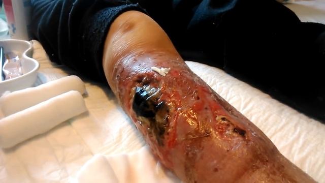 Zabieg Biochirurgiczny Larwa Muchy Lucilia Sericata смотреть онлайн