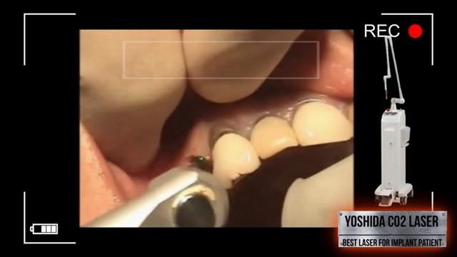 Dental implant abutment procedure with Dental CO2 laser смотреть онлайн