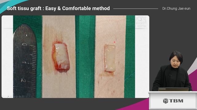 Ora-Aid Webinar - Soft tissue graft - Case Report смотреть онлайн