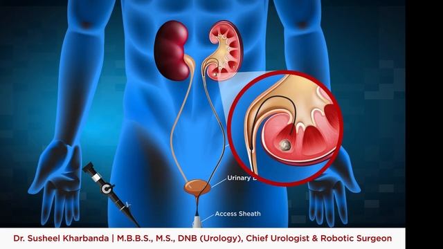 RIRS ADVANCED LASER TREATMENT FOR KIDNEY STONES BY DR SUSHEEL KHARBANDA смотреть онлайн