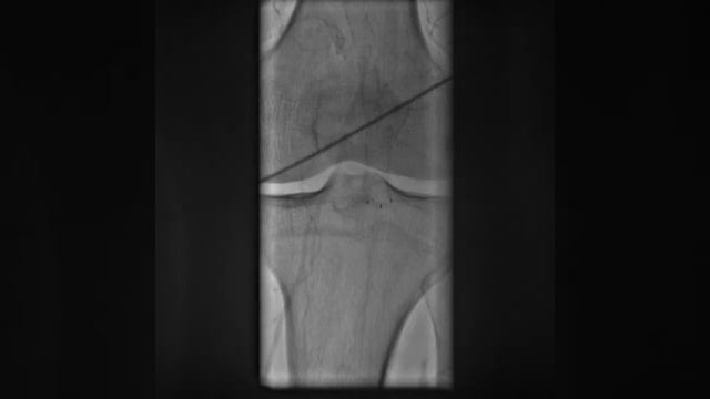 Oclusion of femoral and tibial artery stents Ass professor Vasilevsky V P смотреть онлайн