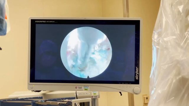 Right L4-5 Laser Endoscopic Transforaminal Discectomy смотреть онлайн