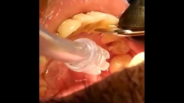 How To Remove Plaque And Tartar From Teeth  -  Dental Scaling