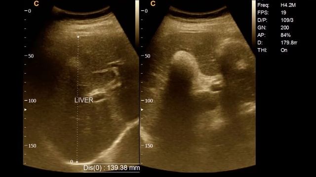 Large gut bowel abstraction | GB stone | Ultrasound | Report | Amader hospital | আমাদের হাসপাতাল смотреть онлайн