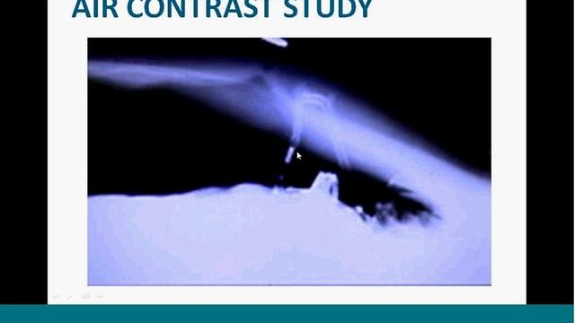 Peritoneal Dialysis: The Evolution of Treatment and Options by Tom Tucker, MD смотреть онлайн