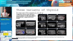Ushakov AV Pathogenesis of thyroid stromal swelling || BGRS/SB-2024