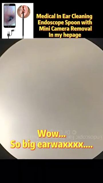 Best Ear Wax Removal & Extraction with Vacuum Remover 真空リムーバーによるにきびの除去と抽出 78 смотреть онлайн