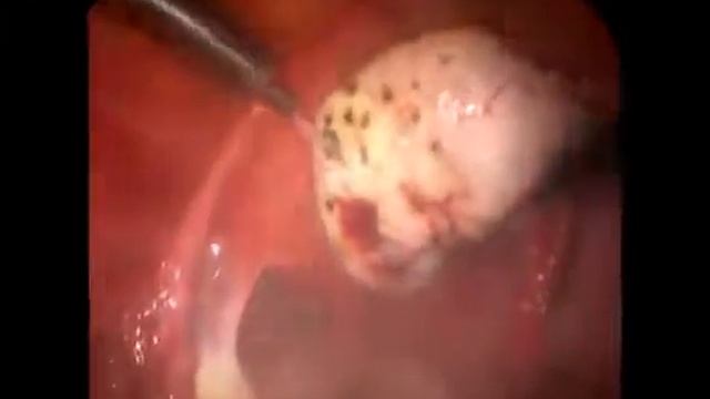 Drilling LASER DIODO Sindrome Ovario Poliquistico смотреть онлайн