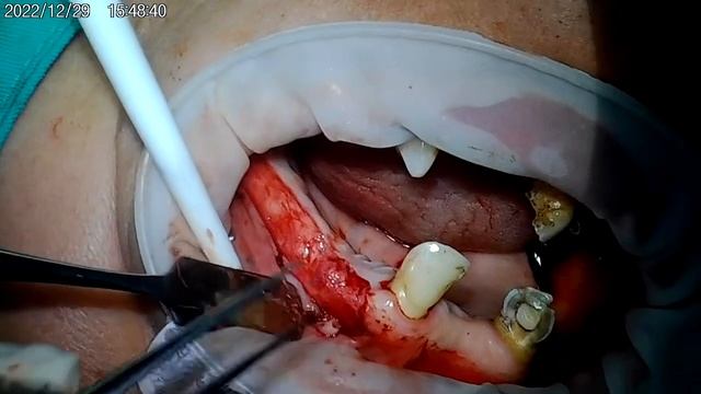 20221229王先生左上APF with partial flap and osseous and surgiaid with oral aid dressing смотреть онлайн