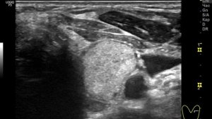 Узел щитовидной железы. Зачем ОПЕРАЦИЯ? Ошибки в УЗИ щитовидной. Что и Как? // Доктор Ушаков