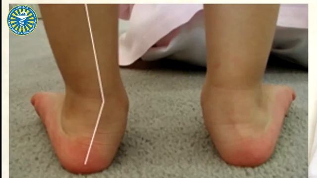 Май таман кандай оору?#плоскостопие #ортопедНурбекРыскулов смотреть онлайн