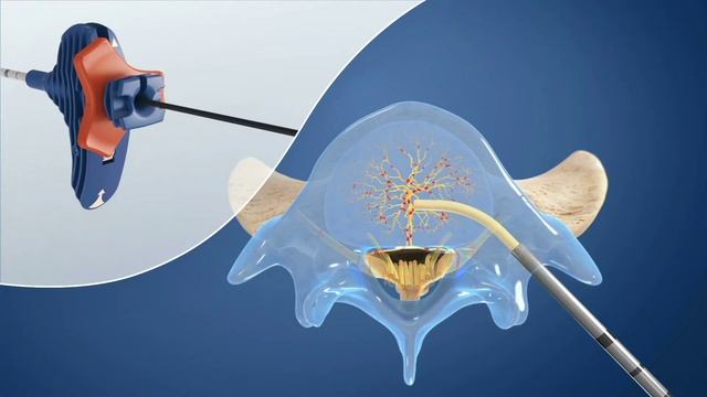 The Relievant Intracept Procedure смотреть онлайн