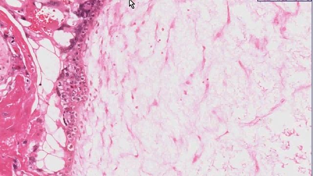 Histopathology Uterus, corpus, placenta--Hydatidiform mole смотреть онлайн