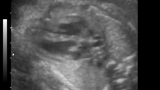 TRANSPOZITIA VASELOR MAGISTRALE CARDIACE смотреть онлайн