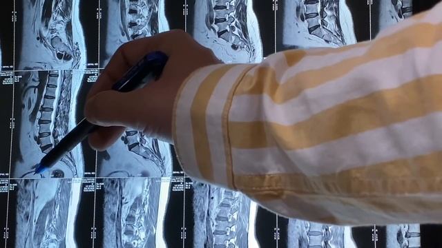X ray or MRI in Disc Bulge? Lumbar Spine MRI, Lower Back X ray, Herniated Disc MRI, Disc Protrusion смотреть онлайн