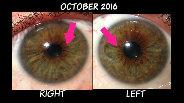 6 Month Iris Comparison April-October 2016 Iridology Review Dr. Robert Morse ND смотреть онлайн