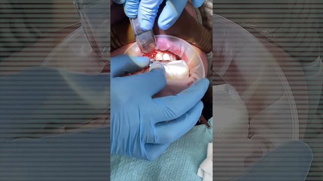 Dental Implant to Replace Missing Front Tooth смотреть онлайн