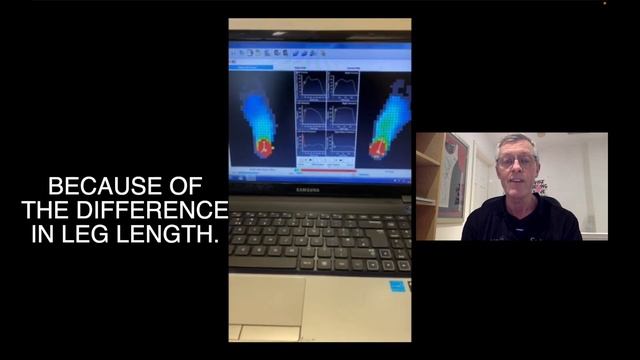 CASE STUDY 2: Pes Plano Valgus on a short leg. смотреть онлайн