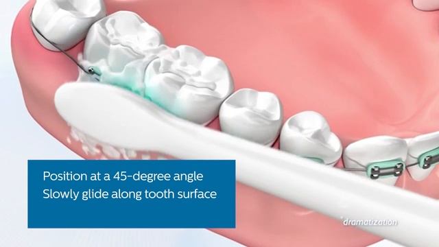 Philips Sonicare Ortho Kit- Philips Oral Healthcare