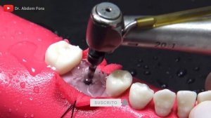 Реальная операция имплантации зубов. Экспертный обзор.