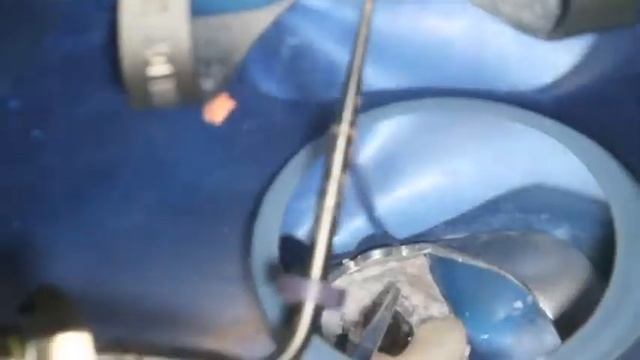 Lateral Condensation / Warm Vertical Hybrid Technique смотреть онлайн
