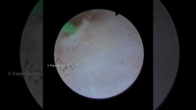 Narrow iNfundibulum смотреть онлайн