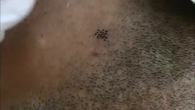 Scalp Micro Pigmentation in Vinci Hair Clinic Beirut, Lebanon смотреть онлайн