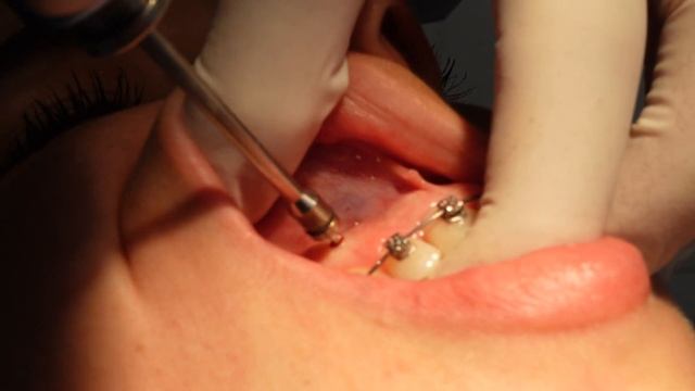 LE PONEN DOS MICRO TORNILLOS EN SU HUESO -CASO REAL -MINI IMPLANTES EN ORTODONCIA ¿CÒMO SE PONEN? смотреть онлайн