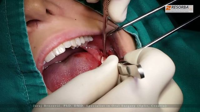 Parasorb Cone Genta смотреть онлайн