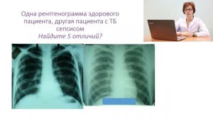 Видеолекция Туберкулез и ВИЧ инфекция