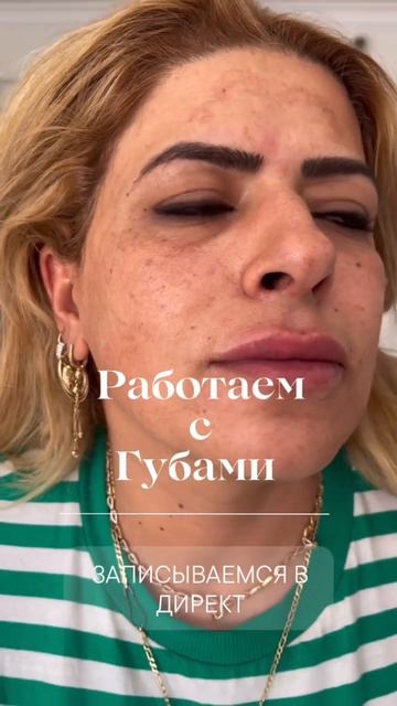Увеличение губ. Контурная пластика губ. #shorts смотреть онлайн
