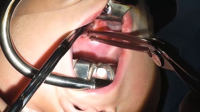 RF Tonsillectomy with To-BiTE™ non-stick Bipolar Clamp | Cameron McIntosh, MD смотреть онлайн
