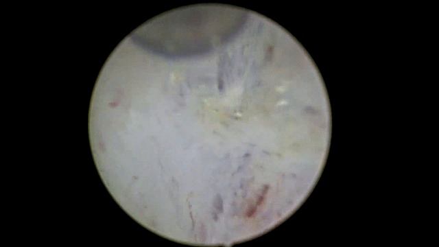 HoLEP. Enucleación en bloque. Auriga XL. Dr Sola смотреть онлайн