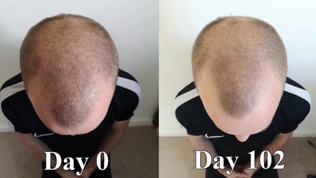 Scalp Massage for Hair Regrowth (24 Week Experiment) смотреть онлайн